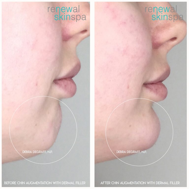 Botox for Neck Band | Wrinkles | Chin Dimple Area | | Renewal Skin Spa
