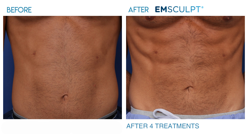 Image result for emsculpt before and after