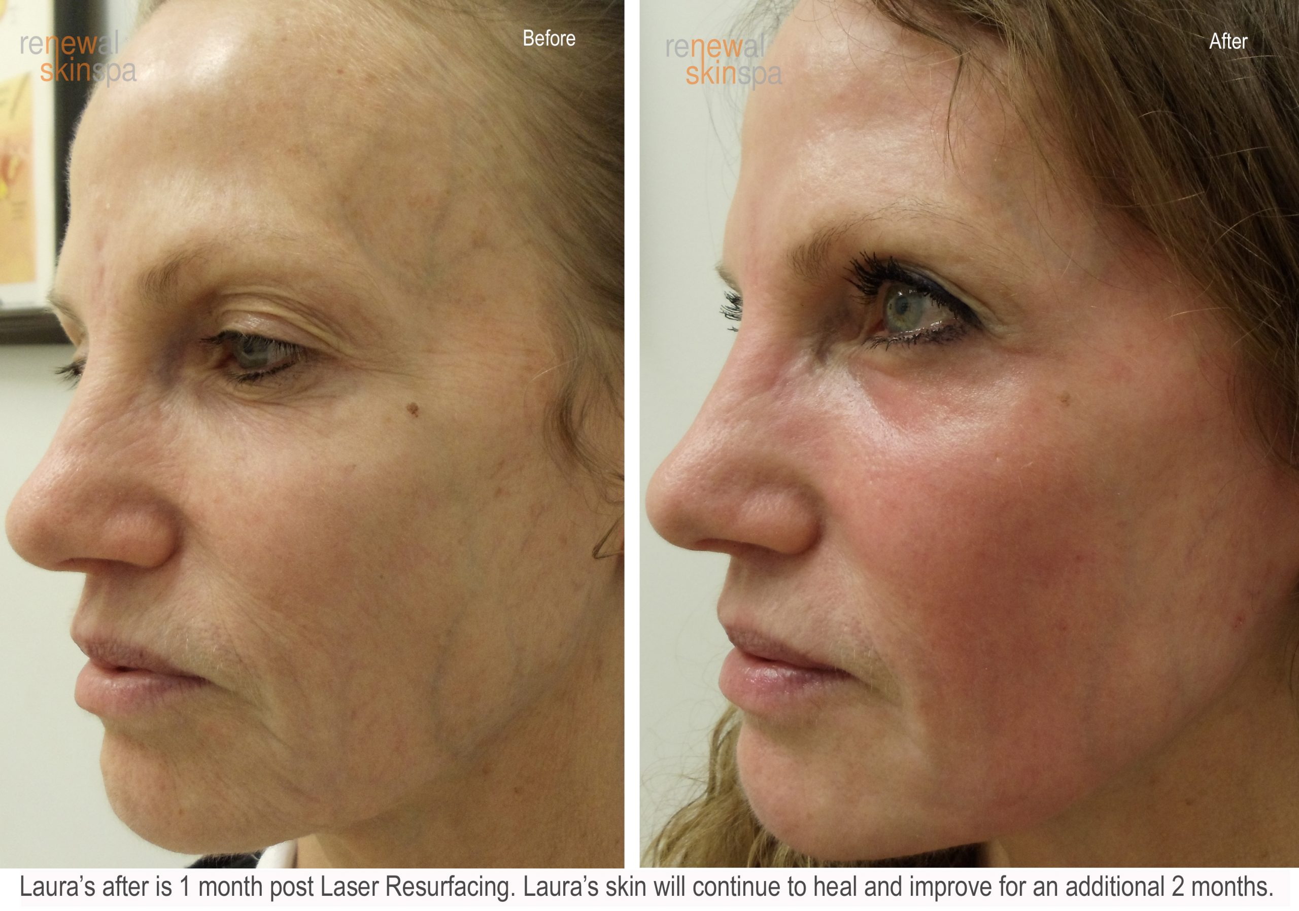 crecer amenazar alimentar Laser Skin Resurfacing Grand Rapids | Best Sking Resurfacing MI | Renewal  Skin Spa