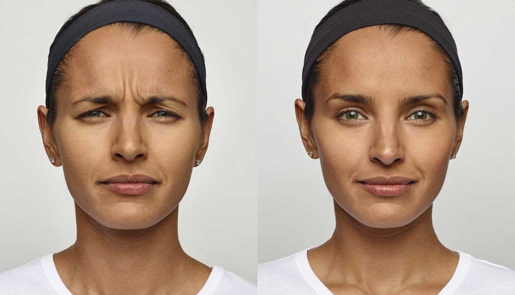 Renewal Skin Spa dysportbeforeandafter