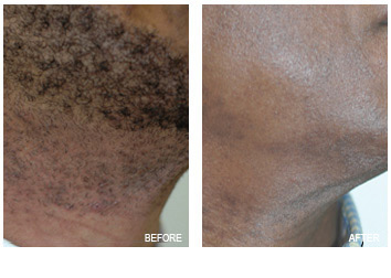 Laser Hair Removal Grand Rapids | Renewal Skin Spa