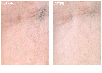 Vein Removal Grand Rapids, Laser Vein Treatment