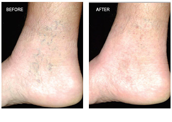 Vein Removal Grand Rapids, Laser Vein Treatment